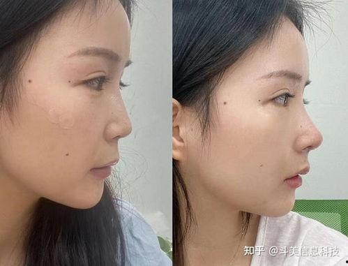 杭州整容爆料案件最新,揭开美容行业潜规则与维权困境